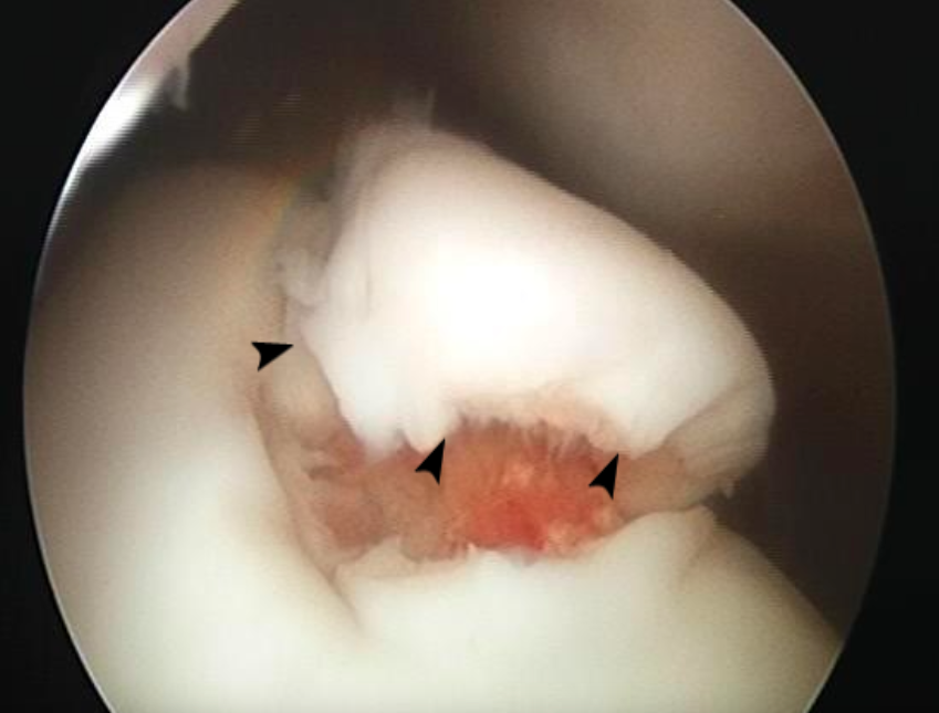 BVP - Equine Arthroscopy - Stifle arthroscopy